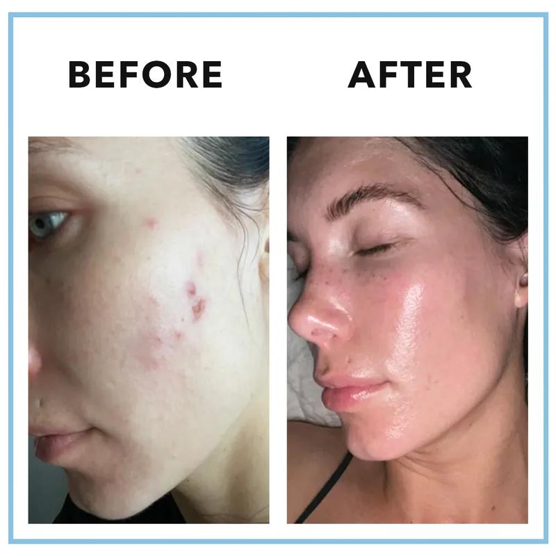 Bloombel™- Clearstem Acne supplement